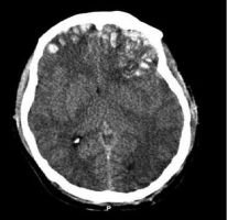 CT scan of traumatic brain injury showing bilateral frontal lobe damage.